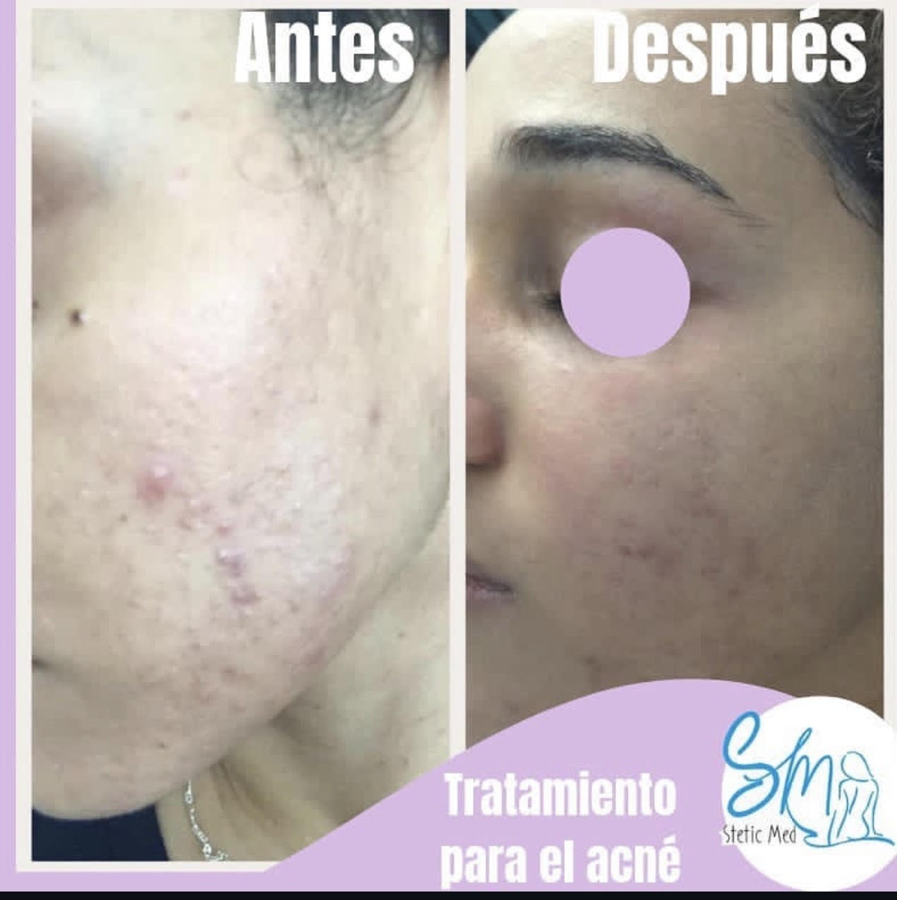 Before and after acne treatment result