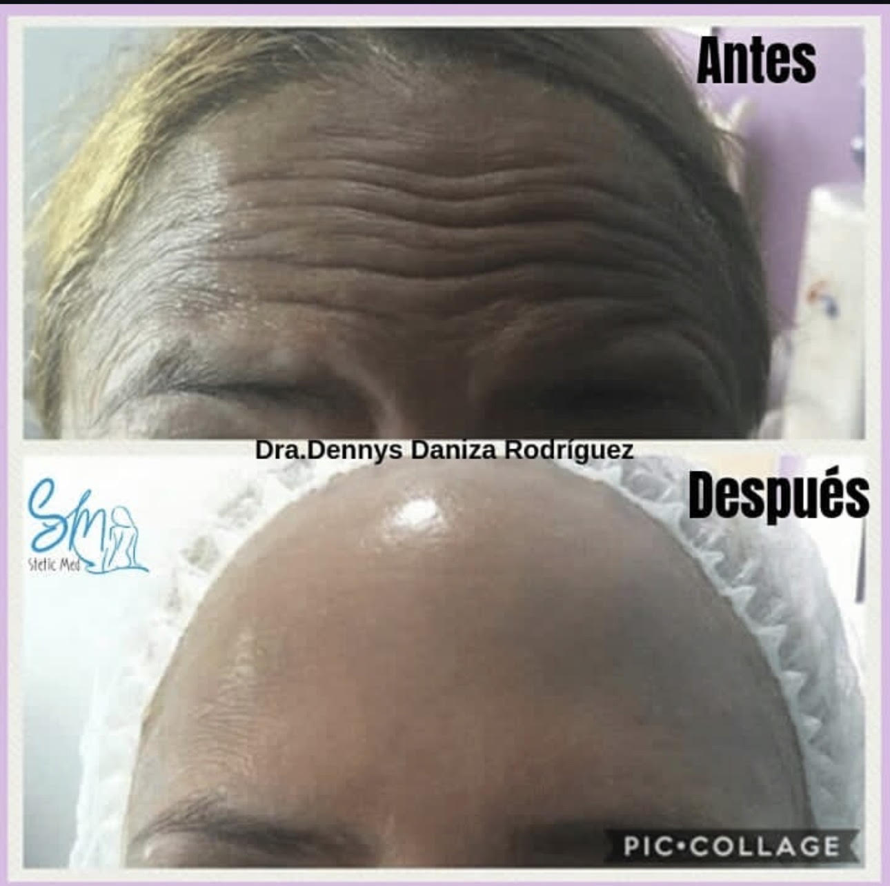 Before and after forehead line treatment result