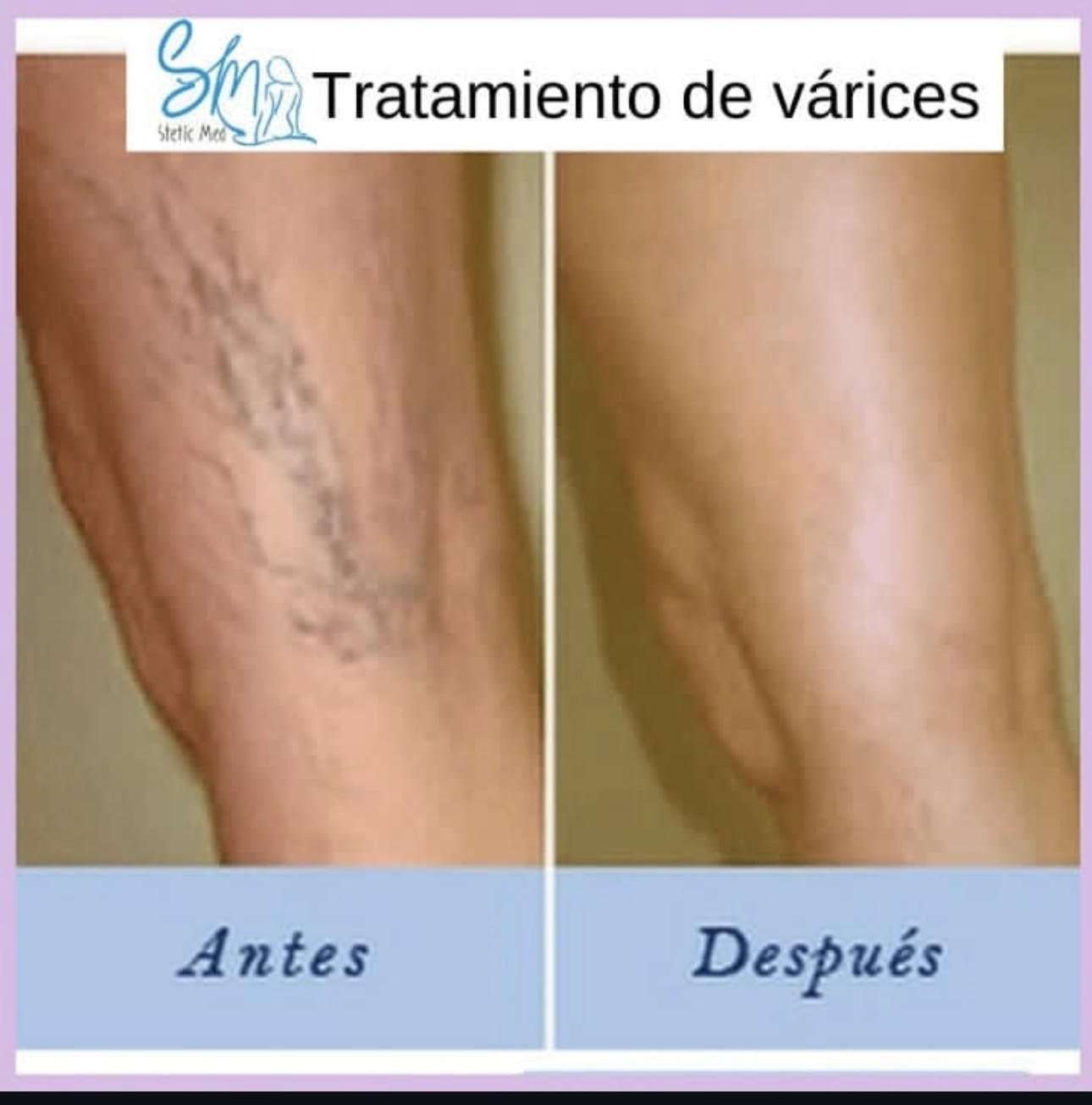 Before and after varicose vein treatment result